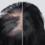 Alopecia/Hair Fall Reasons and Treatment in Homeopathy