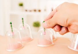 hijama therapy