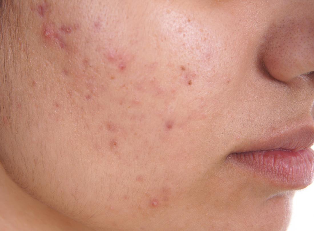 Hijama Therapy for Acne